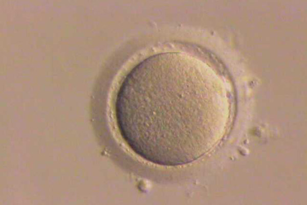 In Vitro Fertilization